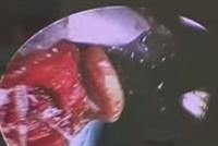  بالفيديو.. إنجاز طبي هو الأول من نوعه في لبنان