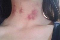 ما لا تعرفه عن البقع الحمراء ما بعد الجماع!