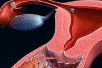 كيف يمكن للفتاة معرفة هل غشاء البكارة موجود أم لا بدون طبيب