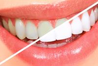 طريقة بسيطة للتخلص من تسوس الاسنان في المنزل.. جربوها!