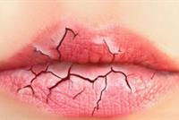 تشقق الشفاه في الشتاء سببه هذه الأخطاء