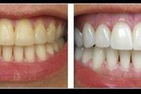  لا تفوتها .. وصفة طبيعية لتبييض الأسنان الصفراء؟!