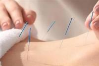 الوخز بالإبر لخسارة الوزن بسرعة فائقة