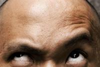 طريقة جديدة لمكافحة الصلع