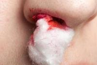  ما سبب نزيف الأنف وكيف نوقفه؟