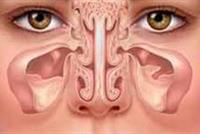 علاجات منزلية لتخفيف آلام الجيوب الأنفية