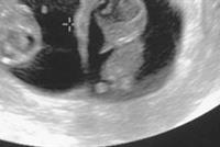  هكذا تكتشفين إن كنت حامل بتوأم