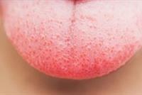 لون اللسان يعكس حالتك الصحية