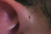 ما سبب وجود ثقوب صغيرة فوق الأذن عند بعض الأشخاص؟ 