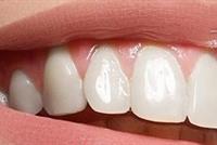 شروط هامة لتبييض الأسنان