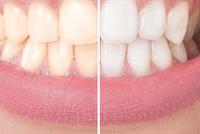 تبييض الاسنان طبيعياً وبدون أضرار