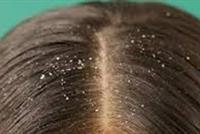  تعرفوا الى أسباب القشرة وكيف تتخلصون منها 