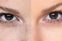  ما هو الوقت المناسب للتخلص من البقع الداكنة؟ وكيف؟ 