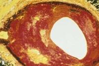 اكتشاف دواء لتصلب الشرايين