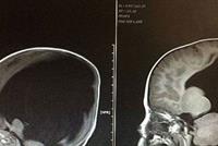 ولد من دون دماغ... حالة هذا الطفل حيّرت الأطباء