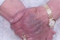 تعرَّف سر الكدمة الزرقاء على يد الملكة إليزابيث