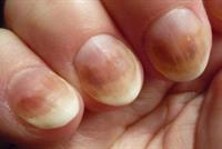 تغير لون الأظافر دليل على الإصابة بمرض