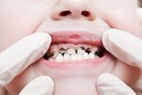 إصابة أسنان الأطفال بالتسوس لا ترتبط بعوامل وراثية