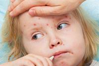 الصحة العالمية: 34 ألف إصابة بالحصبة بأوروبا هذا العام