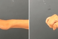 لأول مرة.. جراحة تعيد وظائف اليد والذراع للمصابين بالشلل