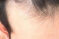 أول بنك للشعر في العالم لمكافحة الصلع