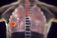 علماء أميركيون يكشفون عن عضو أساسي يتلفه كورونا بعد مهاجمة الرئتين!