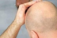 الصلع يزيد احتمال نقل مرضى 